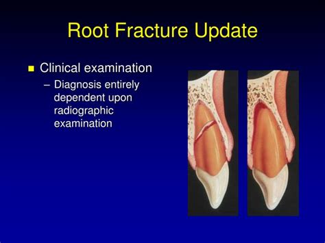 PPT - Traumatic Injuries to the Teeth PowerPoint Presentation - ID:1214569