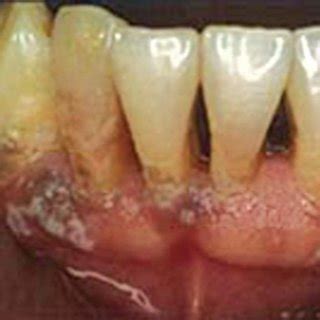 Hyperplastic Candidiasis a | Download Scientific Diagram