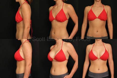Bad Breast Implants Before And After