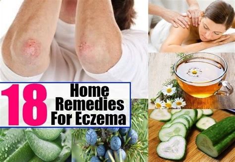 Remedies For Eczema | Como quitar, Salud