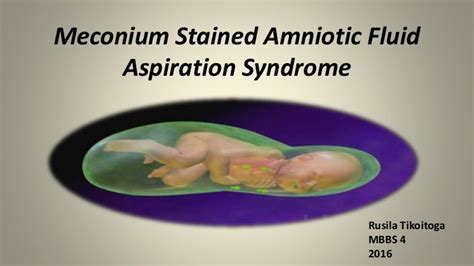 Meconium stained amniotic fluid aspiration syndrome