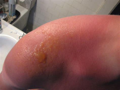 File:Sunburn blisters.jpg - Wikipedia