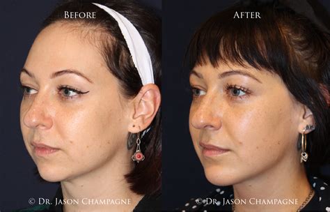 Advanced Radio Frequency Skin Tightening Gallery | Beverly Hills Plastic Surgeon - Dr. Jason ...