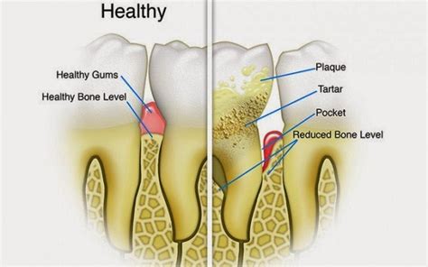 The Difference Between Plaque and Tartar | Upper Bluffs Dental