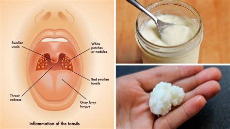 3 Powerful Home Remedies for Tonsil Stones That Work Fast ...