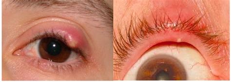 Stye: What is it, causes, treatment and prevention | Eye Health