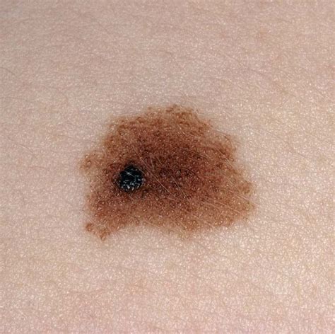 Dysplastic Nevus (ICD-10 : D22) - Online consultation AI dermatologist