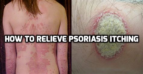 How to Relieve Psoriasis Itching - Psoriasis Self Management