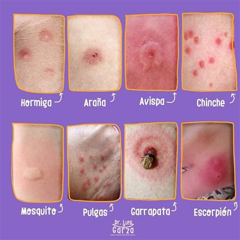 different types of acne on the skin