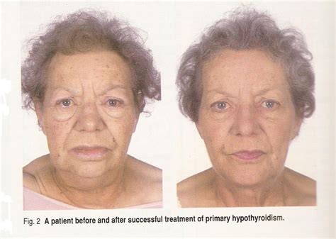 Hypothyroidism Face Before and After ** Want to know more, click on the image. | Hyperthyroidism ...