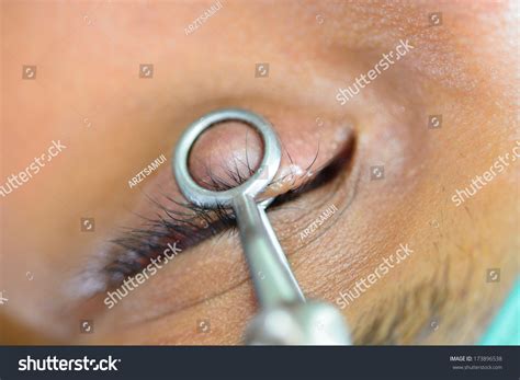 Chalazion Operation Incision Curettage 스톡 사진 173896538 | Shutterstock