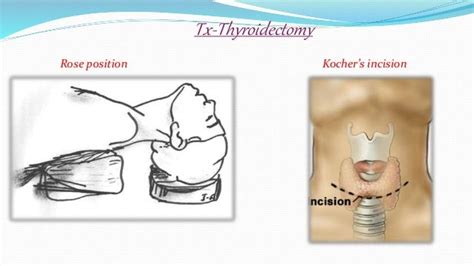 Differentiated thyroid carcinoma