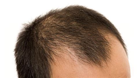 Male Pattern Baldness (Androgenic Alopecia): Stages, Treatment