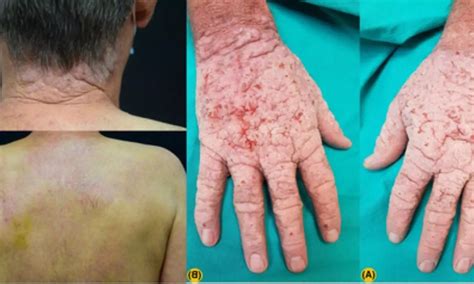 Case of chronic actinic dermatitis gets successfully treated with ...