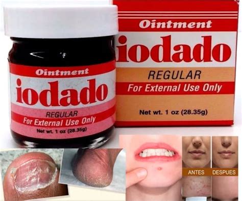 IODINE OINTMENT POVIDONE Iodine Antiseptic for Ulcers, Burns and Scalds CUTS 1OZ £8.03 - PicClick UK