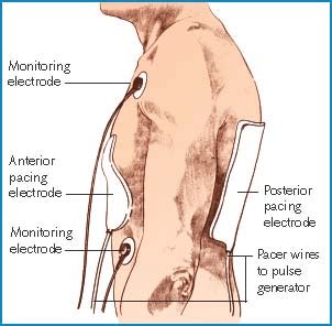 Transcutaneous Pacing | Nurse Key