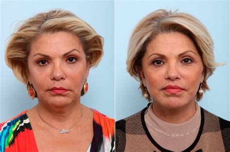 Essential Steps for a Successful Lip Lift Recovery | Houston, TX