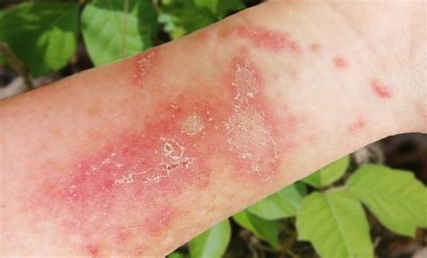 Poison Oak Rash Pictures Causes Symptoms Treatment Co - vrogue.co