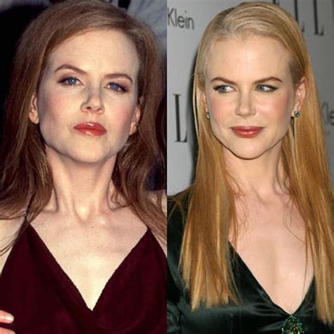 Nicole Kidman: The Evolution Through Plastic Surgery