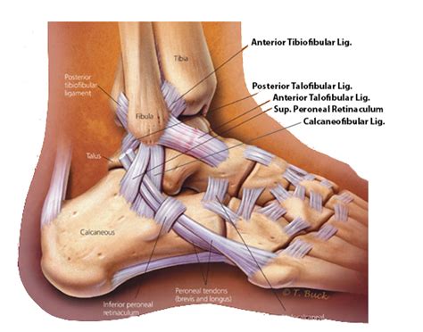 Ankle Sprain - Foot & Ankle - Orthobullets