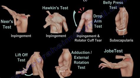 Shoulder Examination / Subacromial, Cuff - Everything You Need To Know ...