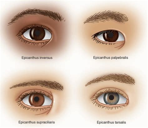 Epicanthal Fold Repair | Ento Key