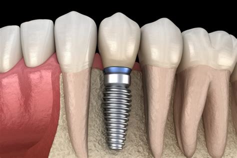 How to Recognize the Most Common Complications of Dental Implants ...