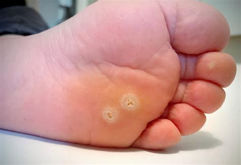 Are You at Risk for Plantar Warts?: Hubert Lee, DPM: Podiatrist