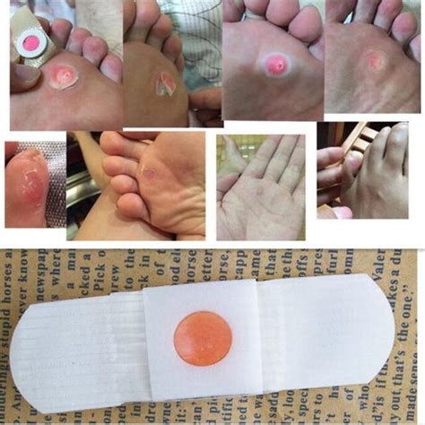 The New 5 PCS Corn Removal Plaster Painless Rapid Eliminate Of Corns Hands And feet Meat Thorn ...