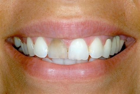 Tooth Bonding Treatment - Bhardwajdentalclinic