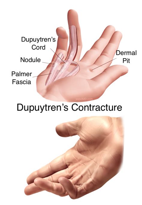 Dupuytren’s Contracture 2