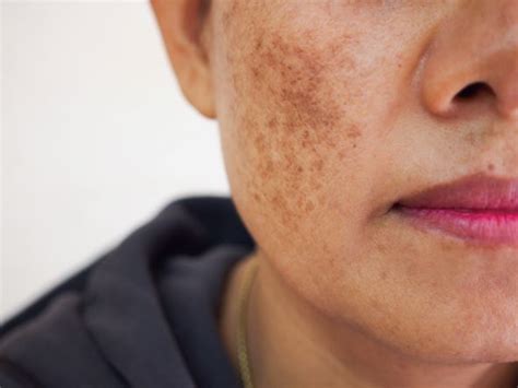 Hyperpigmentation | Treatment, Types and Causes