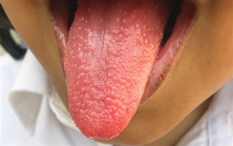 Strawberry Tongue in Streptococcal Pharyngitis | NEJM