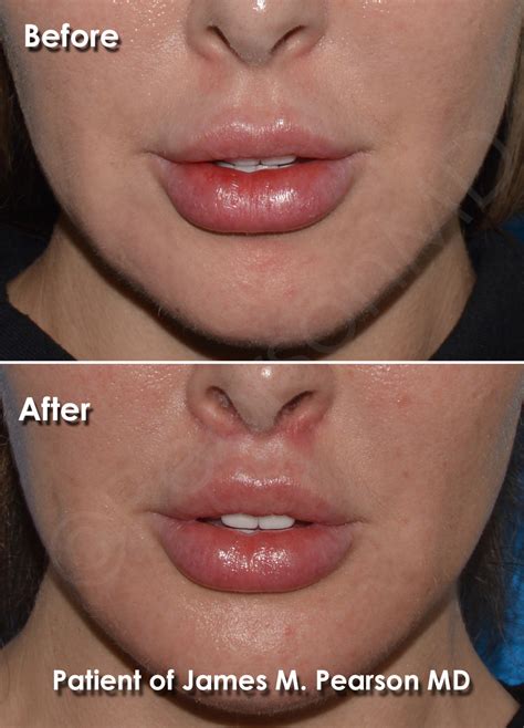 Lip Lift Photos - Before & After - Dr. James Pearson Facial Plastic Surgery