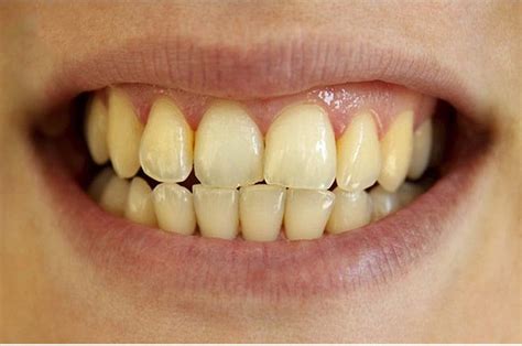 Yellow teeth: Causes and treatment | Vinmec