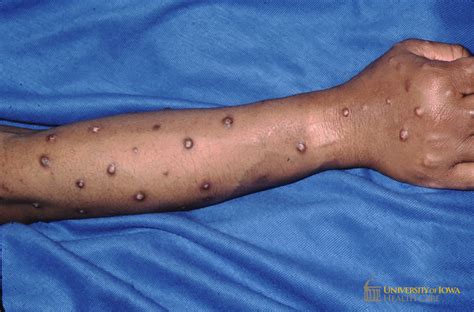 Multiple crusted hypopigmened nodules and plaques with rim of hyperpigmentation on the arm ...