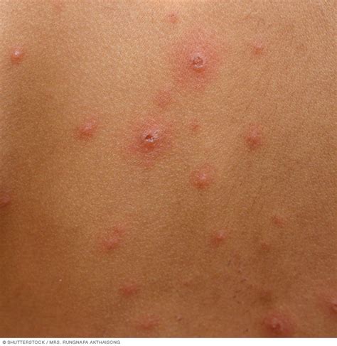 Chickenpox - Symptoms and causes (2023)