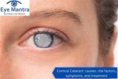 Cortical Cataract Surgery: Causes, Risks, Symptoms, Treatment