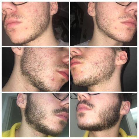 18 y/o. Was told I can’t grow a beard and started using minoxidil. Top is about 2-3 weeks before ...