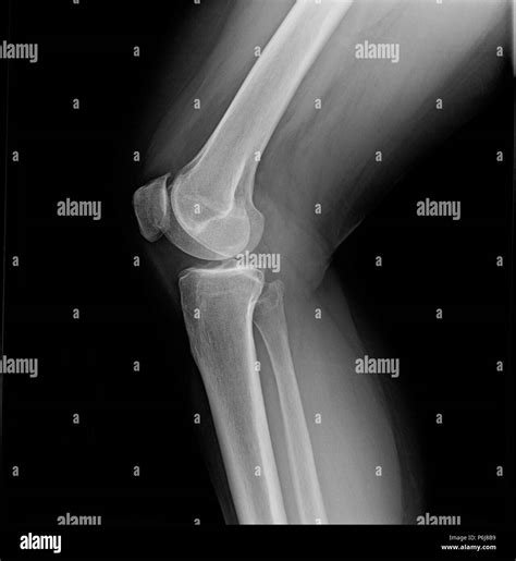 Bone Spur Stock Photos & Bone Spur Stock Images - Alamy