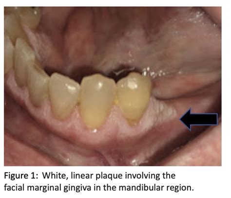 White Oral Lesions That Need Your Attention