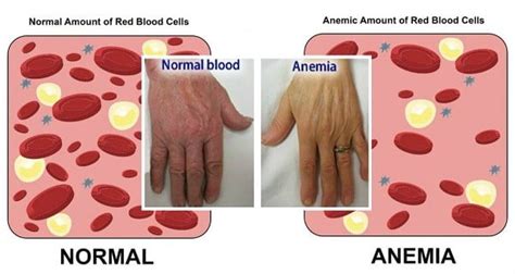 Iron-Deficiency Anemia - Expert Holistic Health Nutrition Information and Consultation,