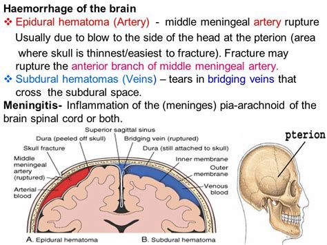 Related image | Epidural hematoma, Medicine illustration, Arteries