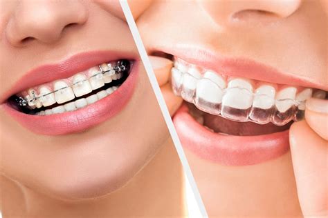 Orthodontics Australia | Traditional Braces vs Clear Aligners