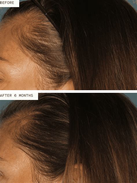 Nutrafol - Before and After | Columbia Laser Skin Center