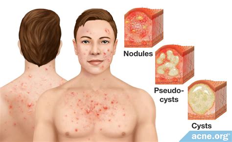 Cystic Acne on the Body - Acne.org