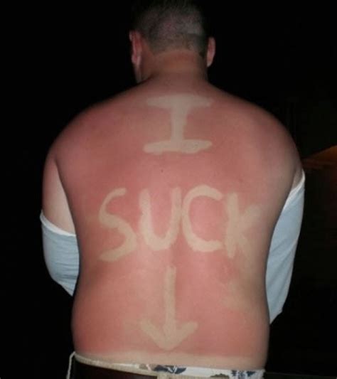 There's A New Social Media Craze Alert That Involves Burning ‘Sun Tattoos’ Onto Your Skin