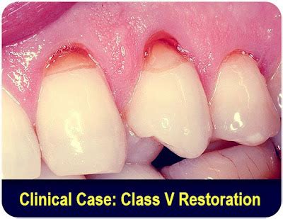 CLASS V RESTORATION: Clinical Case - Dr. Ahmed Khairy - Odonto-Tv