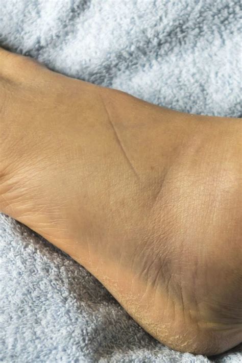 Swollen feet: 15 causes, treatments, and home remedies