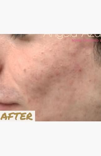 Before & After Gallery Acne | Pediatric And Adult Dermatology located ...